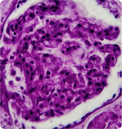 lupus-nephritis